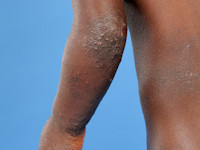 Atopisch eczeem bij donkere huid, strekzijden