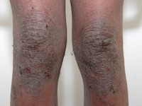 Atopisch eczeem bij donkere huid, strekzijden