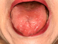Atrofische glossitis 