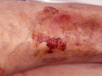 Atrophia cutis senilis