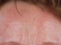 Atrophia cutis senilis