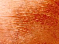 Atrophia cutis senilis