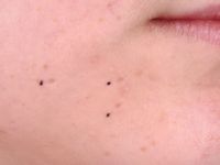 Atrophia maculosa varioliformis cutis