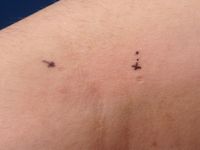 Atrophia maculosa varioliformis cutis