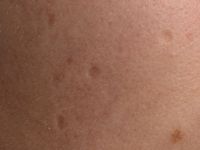 Atrophia maculosa varioliformis cutis