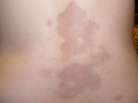 Atrophoderma van Pasini en Pierini