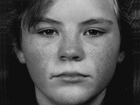 Atrophoderma vermiculata