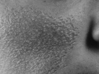 Atrophoderma vermiculata