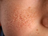 Atrophoderma vermiculata