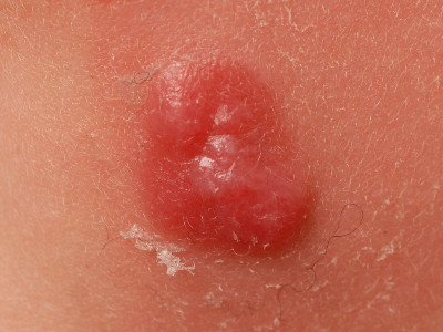 Atypische Spitz naevus