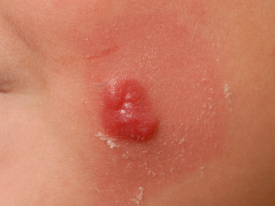 Atypische Spitz naevus