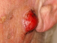 Atypisch fibroxanthoom