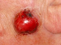 Atypisch fibroxanthoom