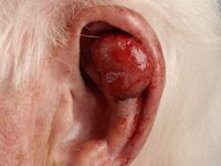 Atypisch fibroxanthoom