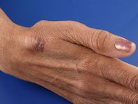 Atypische mycobacteriën