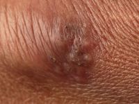 Atypische mycobacteriën