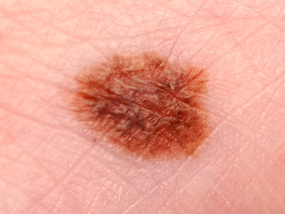 Atypical (dysplastic) nevus