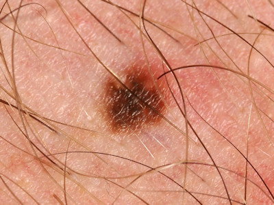 Atypical (dysplastic) nevus