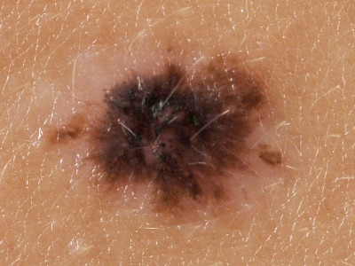 Atypical (dysplastic) nevus