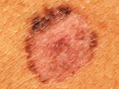 Atypische naevus