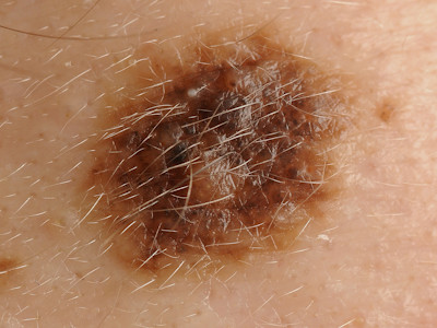 Atypical nevus