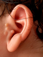 Extra oor (bij-oor, auriculum supplementarium)