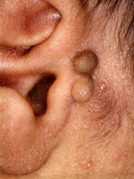 Extra oor (bij-oor, auriculum supplementarium)