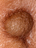 Extra oor (bij-oor, auriculum supplementarium)