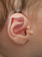 Extra oor (bij-oor, auriculum supplementarium)
