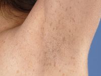 Axillary freckling