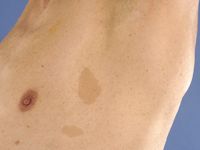 Axillary freckling