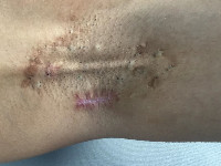 Axillary web syndrome