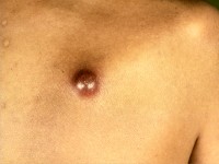 Bacillaire angiomatosis