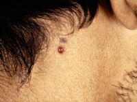 Bacillaire angiomatosis