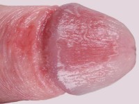 Balanitis circinata
