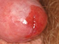 Balanitis of Zoon
