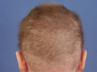 Trichorrhexis invaginata (bamboo hairs)