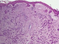 Sprieterig, invasief BCC