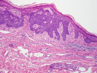 Superficieel (oppervlakkig, romphuidtype) multifocaal BCC