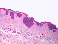 Superficieel (oppervlakkig, romphuidtype) multifocaal BCC