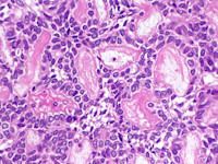 Adenoid basaalcelcarcinoom