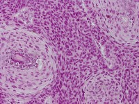 Basosquameus basaalcelcarcinoom