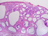 Cysteus basaalcelcarcinoom