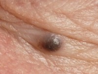 Pigmented basal cell carcinoma