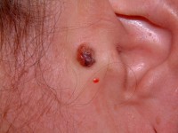 Gepigmenteerd basaalcelcarcinoom