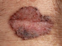 Gepigmenteerd basaalcelcarcinoom