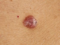 Nodular BCC