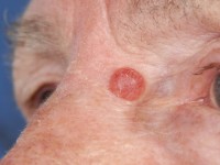 Nodular BCC