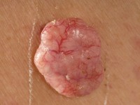 Nodular BCC