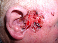 Morpheatype scleroserend basaalcelcarcinoom (histologisch sprieterig)